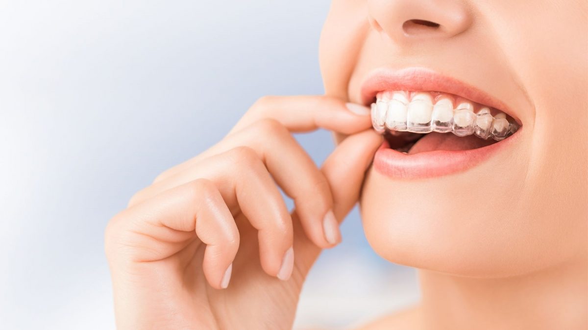 ฟันสวยแบบรวดเร็วด้วยการจัดฟันแบบใส (Invisalign) กับ Plus Dental
