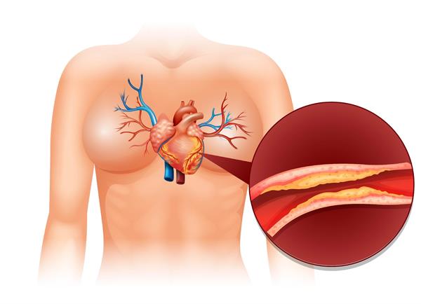 รู้ทัน โรคหลอดเลือดหัวใจ ภัยเงียบที่น่ากลัว แนะ 7 วิธี ดูแลสุขภาพหัวใจให้แข็งแรง