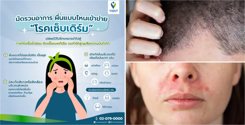 ผื่นแดง เป็นขุย แสบคัน ระวังอาจเป็น "โรคเซ็บเดิร์ม" ภาวะเรื้อรังที่ทำเสียเซลฟ์ แพทย์ รพ.วิมุต แนะ รู้ทันปัจจัยเสี่ยง-รีบพบแพทย์ ก่อนผื่นลุกลามจนอาการหนัก