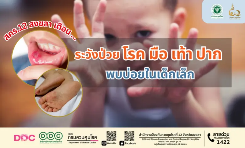 สคร.12 สงขลา เตือน ระวังป่วยโรค มือ เท้า ปาก พบบ่อยในเด็กเล็ก