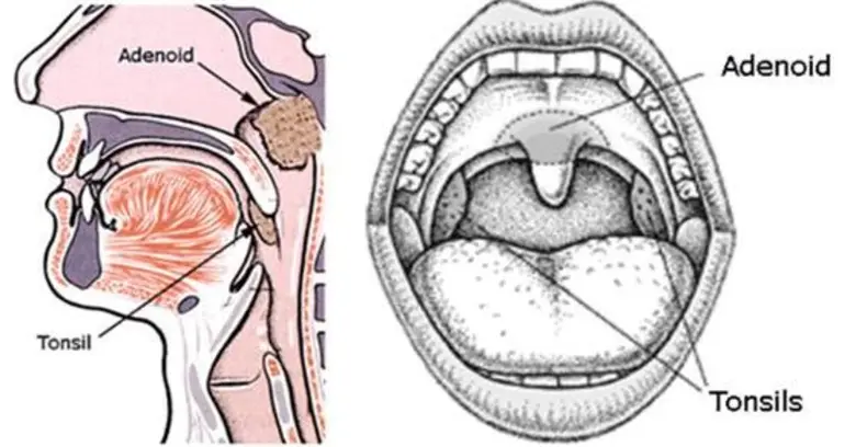 เด็กนอนกรนจากต่อมทอนซิล (Tonsil) และต่อมอะดีนอยด์ (Adenoid)