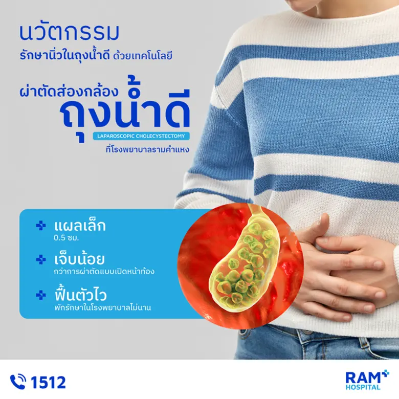นวัตกรรมส่องกล้องรักษา "นิ่วในถุงน้ำดี"แผลเล็ก เจ็บน้อย ฟื้นตัวไว ที่โรงพยาบาลรามคำแหง