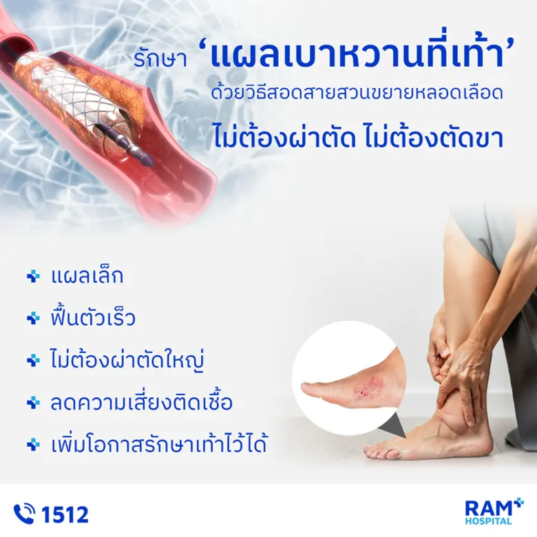 รักษา "แผลเบาหวานที่เท้า" ด้วยวิธีสอดสายสวนขยายหลอดเลือด ไม่ต้องผ่าตัด ไม่ต้องตัดขา