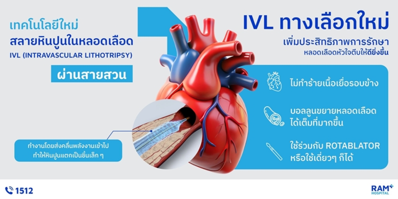 IVL เทคโนโลยีสลายหินปูนในหลอดเลือด ตัวช่วยสำคัญในการรักษาหลอดเลือดหัวใจตีบ
