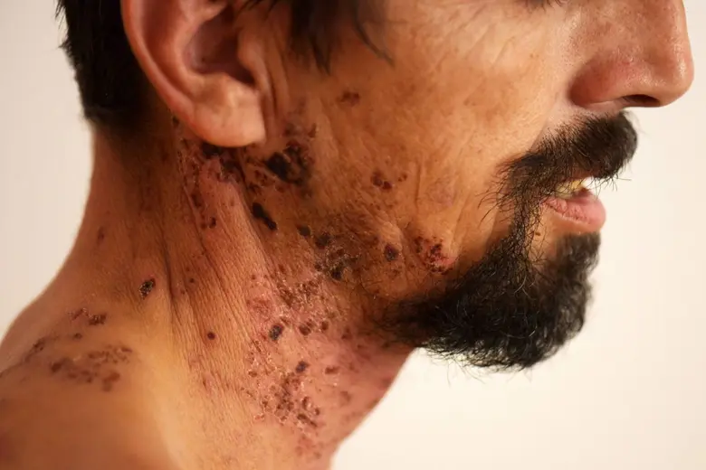 แพทย์ชี้ '1 ใน 3 คน' เสี่ยงเป็นงูสวัดอย่างน้อย 1 ครั้งในชีวิต วัย 50+ และผู้มีโรคร่วม เสี่ยงกระทบสุขภาพรุนแรง