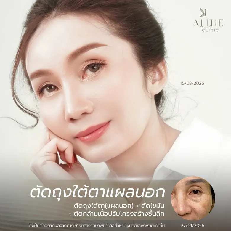 ผ่าตัดถุงใต้ตา ราคาเท่าไหร่? เช็กโปรโมชันล่าสุด พร้อมเทคนิคจัดเรียงไขมันที่ ALINE Clinic