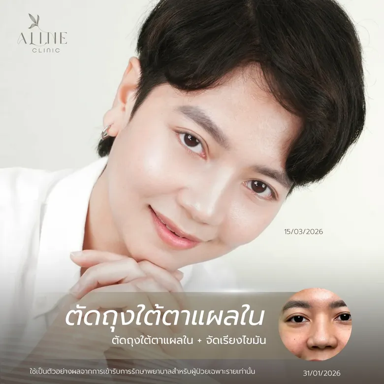 ผ่าตัดถุงใต้ตา ราคาเท่าไหร่? เช็กโปรโมชันล่าสุด พร้อมเทคนิคจัดเรียงไขมันที่ ALINE Clinic