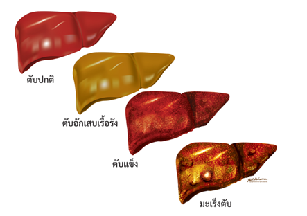 ศูนย์ความเป็นเลิศด้านมะเร็ง โรงพยาบาลพระปกเกล้า จังหวัดจันทบุรี จับมือภาครัฐและเอกชน เปิดโครงการภารกิจพิชิตโรคตับ และ 'EZ Liver Clinic'