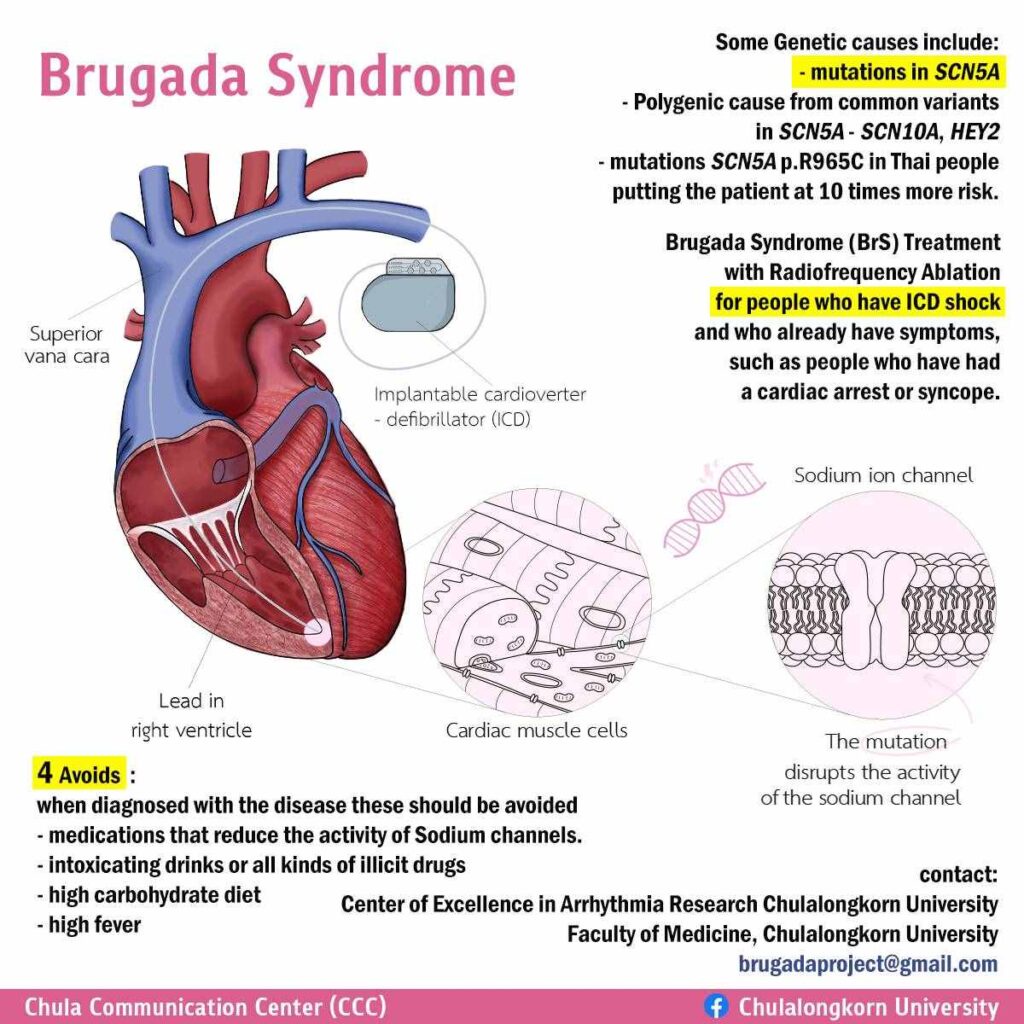 Brugada Syndrome A Silent and Deadly Threat to Thai Men
